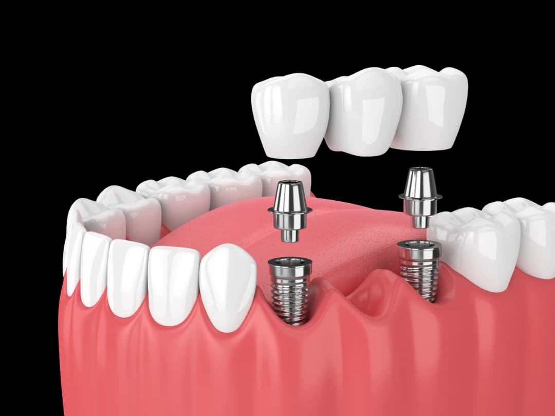 Implant Treatment