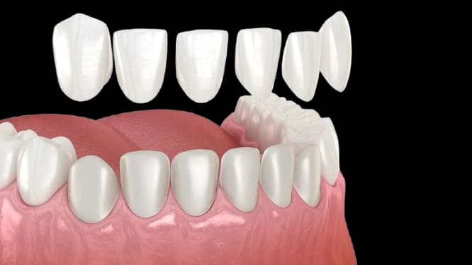 Fațete Dentare (Laminate)